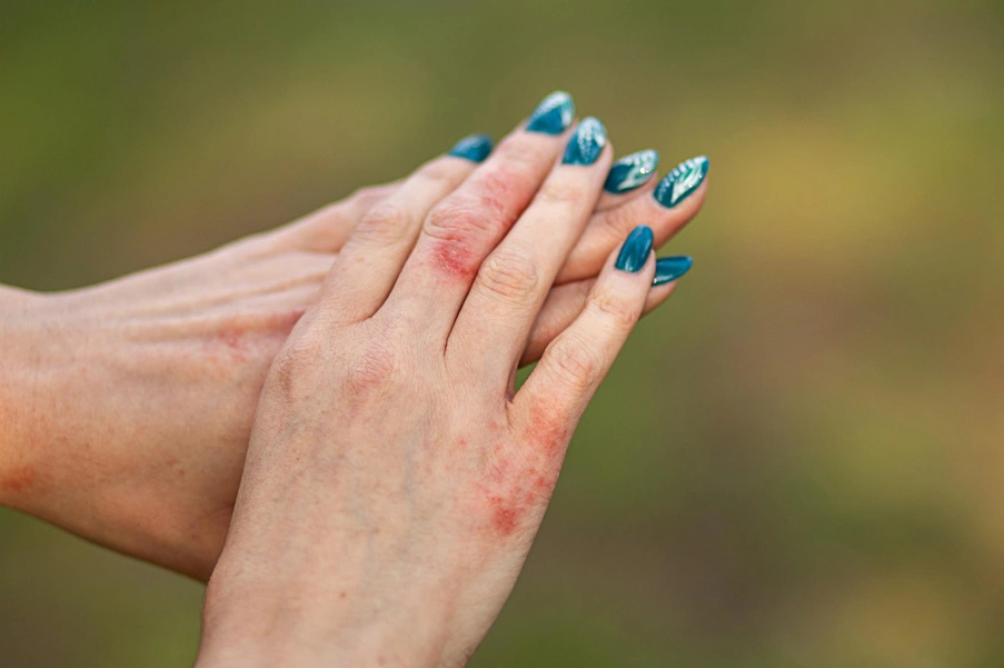 Atopiye Eğilimli Cilt Neden Olur?