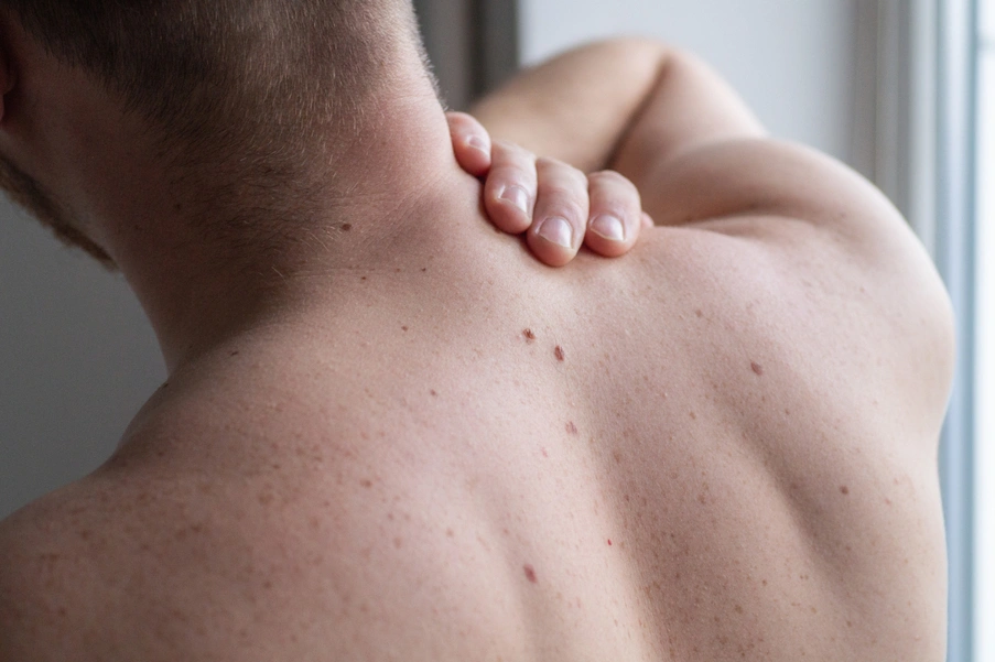 Sırt Cilt Kusuru G&ouml;r&uuml;n&uuml;mlerine Neden Olabilen Fakt&ouml;rler